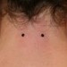 Tattoos - Nape Microdermals  - 39290